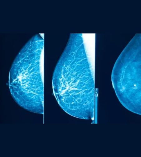 Mammographie montrant trois vues radiographiques d’un sein en nuances de bleu, avec les tissus mammaires
