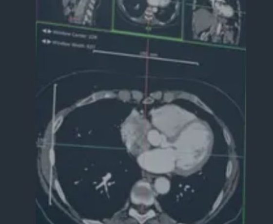 Photo d'une radiographie du cerveau