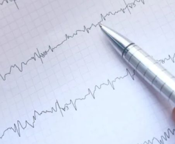 Photo du tracé d'un électrocardiogramme