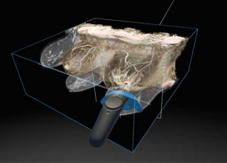 Vue en réalité augmentée pour le traitement du cancer du sein_ Projet plateforme DIVA © DIVA