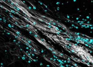 extracellulaire et infiltration immunitaire