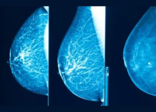 Mammographie montrant trois vues radiographiques d’un sein en nuances de bleu, avec les tissus mammaires